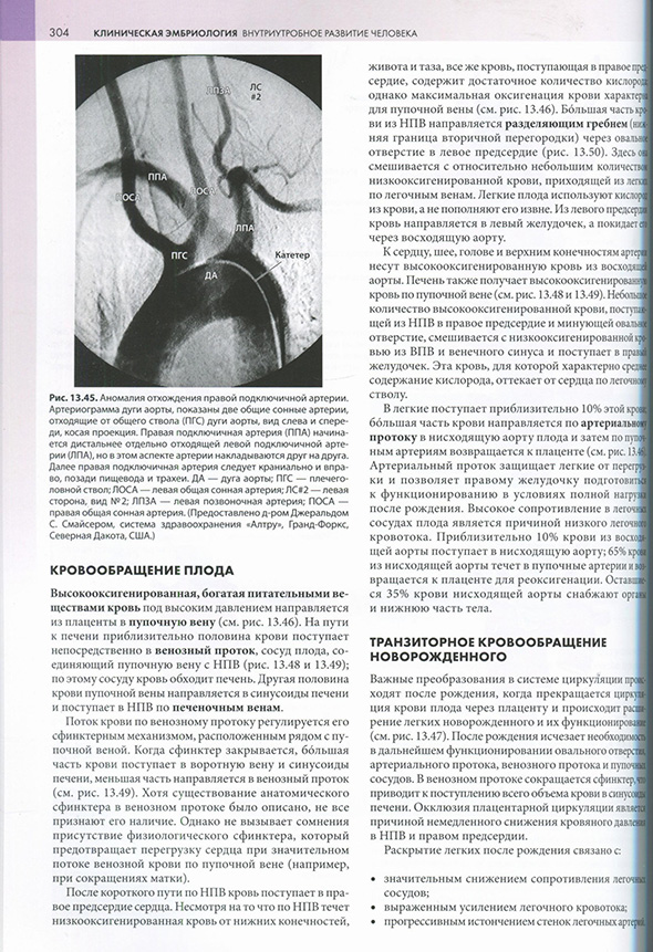 Аномалия отхождения правой подключичной артерии. 