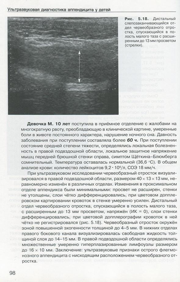 Рис. 5.18. Дистальный слепозаканчивающийся отдел червеобразного отростка. спускающийся в полость малого таза с расширенным до 13 мм просветом (стрелки).