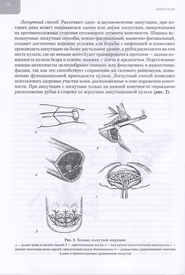 Техника лоскутной операции: Техника лоскутной операции: