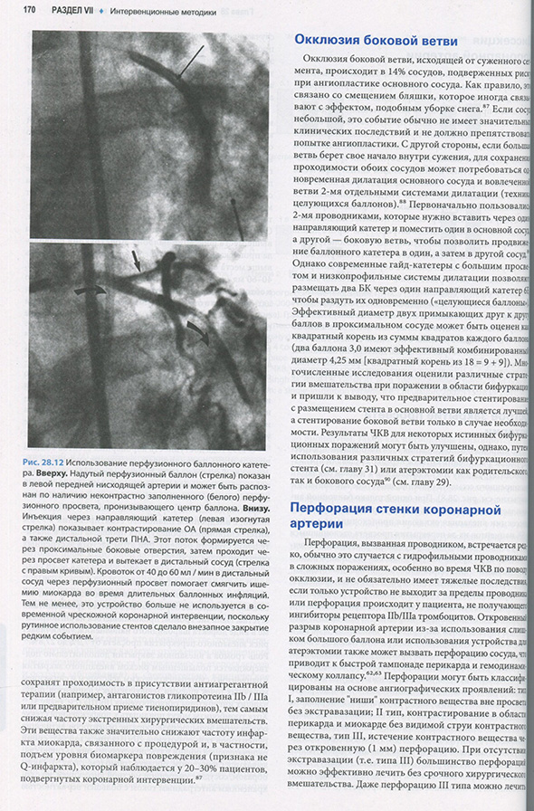 Использование перфузионного баллонного катетера.