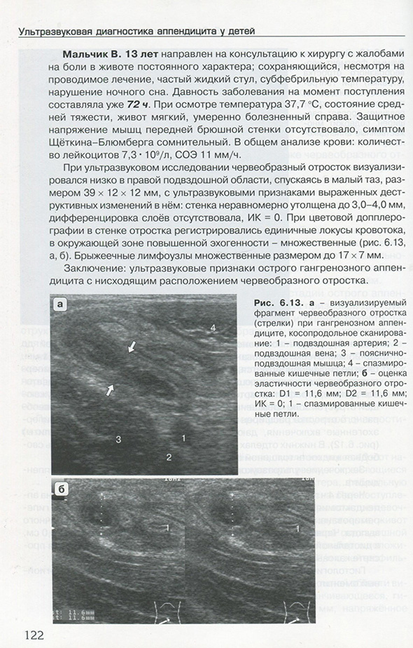 Рис. 6.13. а - визуализируемый фрагмент червеобразного отростка