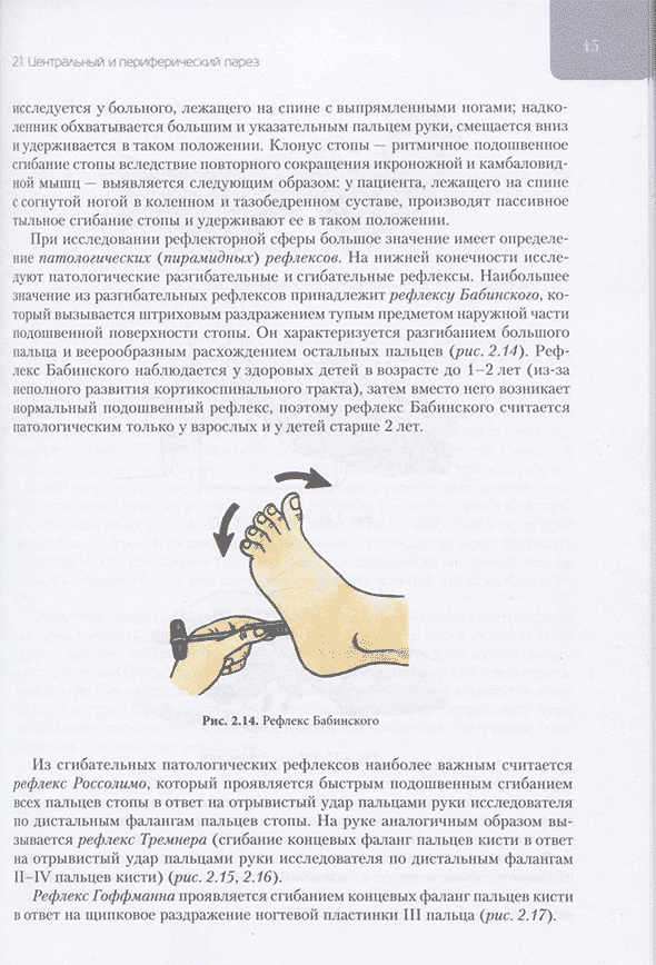Рефлекс Бабинского Рефлекс Бабинского