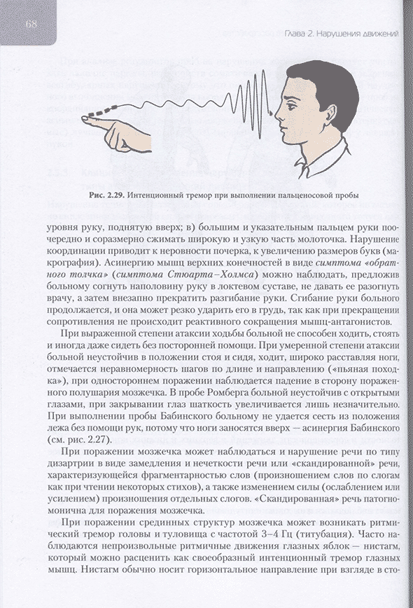 Интенционный тремор при выполнении пальценосовой пробы. Интенционный тремор при выполнении пальценосовой пробы.