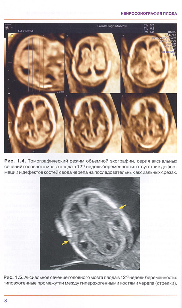 Аксиальное сечение головного мозга плода в 12 недель беременности