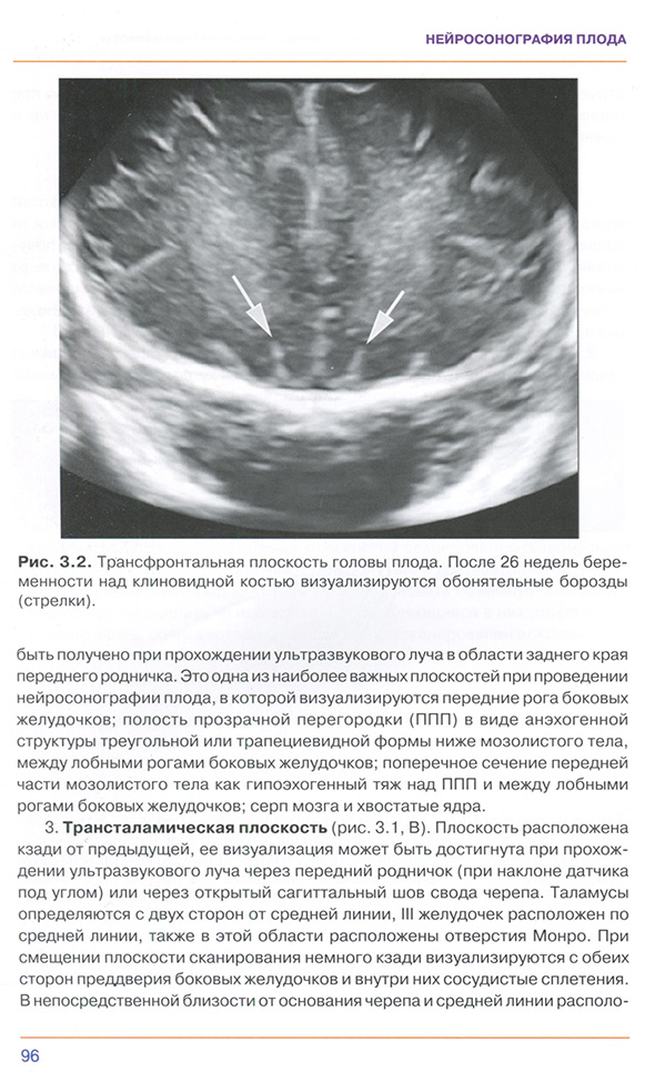 Трансфронтальная плоскость головы плода.