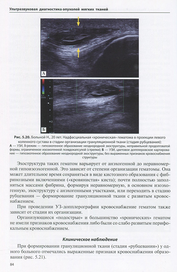 Надфасциальная «хроническая» гематома