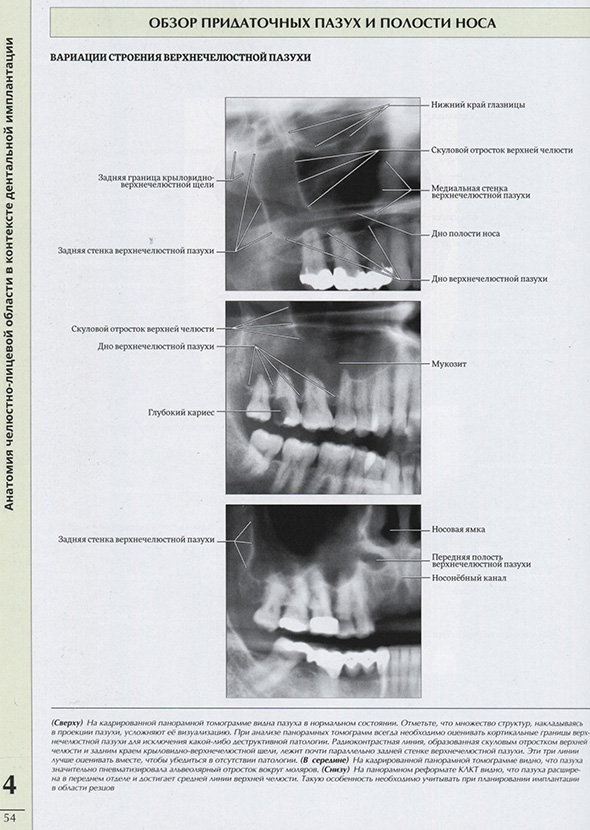 Обзор придаточных пазух и полости носа
