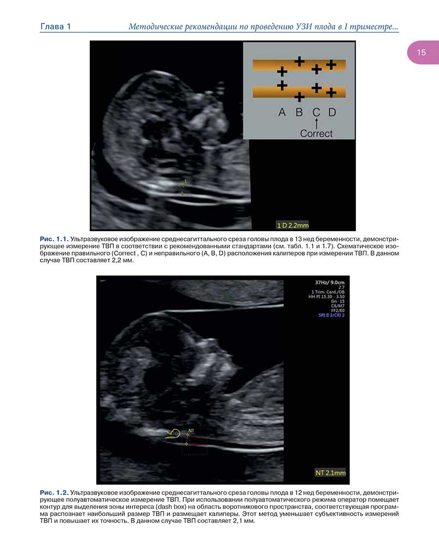Рис. 1.2. Ультразвуковое изображение среднесагиттального среза головы плода в 12 нед беременности,