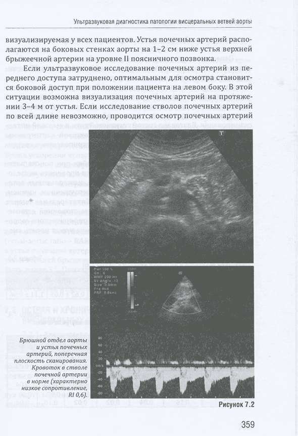 Брюшной отдел аорты и устья почечных артерий, поперечная плоскость сканирования.