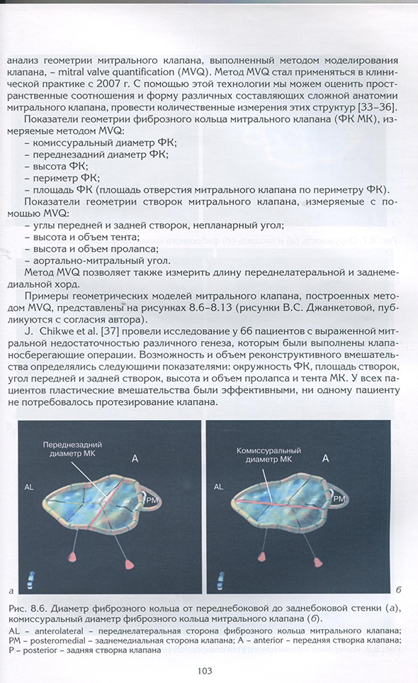 . Диаметр фиброзного кольца от переднебоковой до заднебоковой стенки