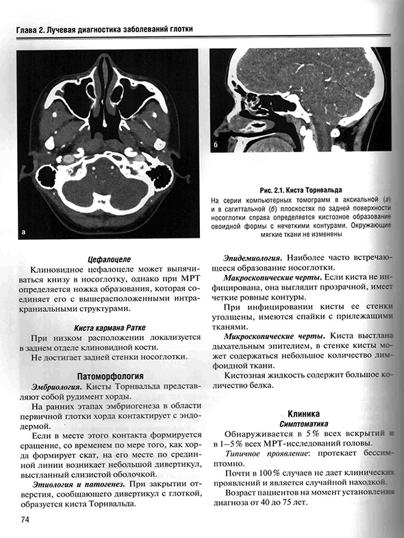 Киста Торнвальда