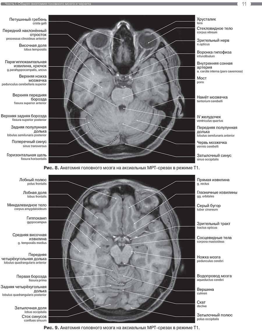 Рис. 9. Анатомия головного мозга на аксиальных MPT-срезах в режиме Т1.
