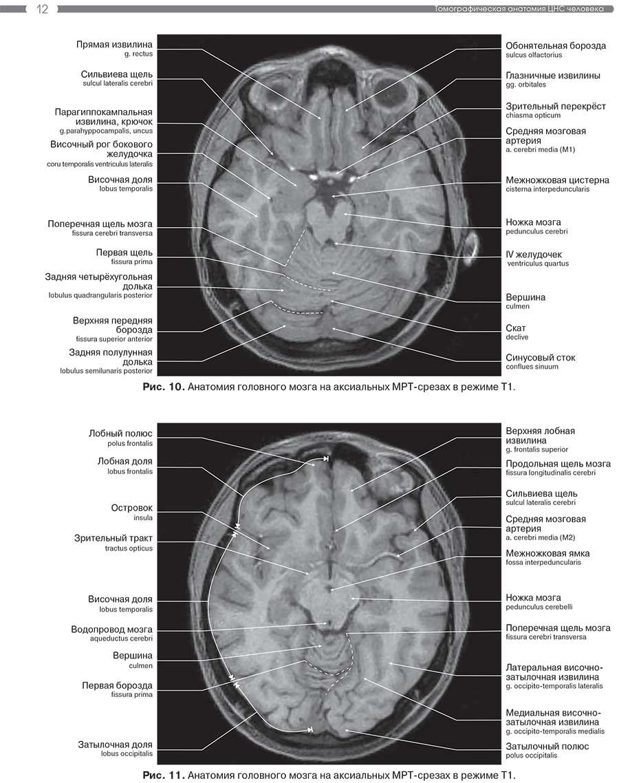 Рис. 11. Анатомия головного мозга на аксиальных MPT-срезах в режиме Т1.