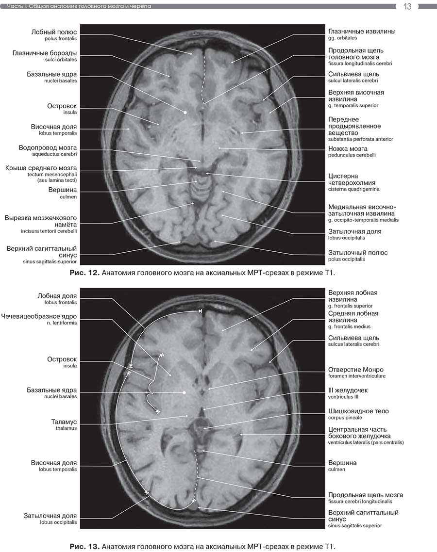 Рис. 13. Анатомия головного мозга на аксиальных MPT-срезах в режиме Т1.