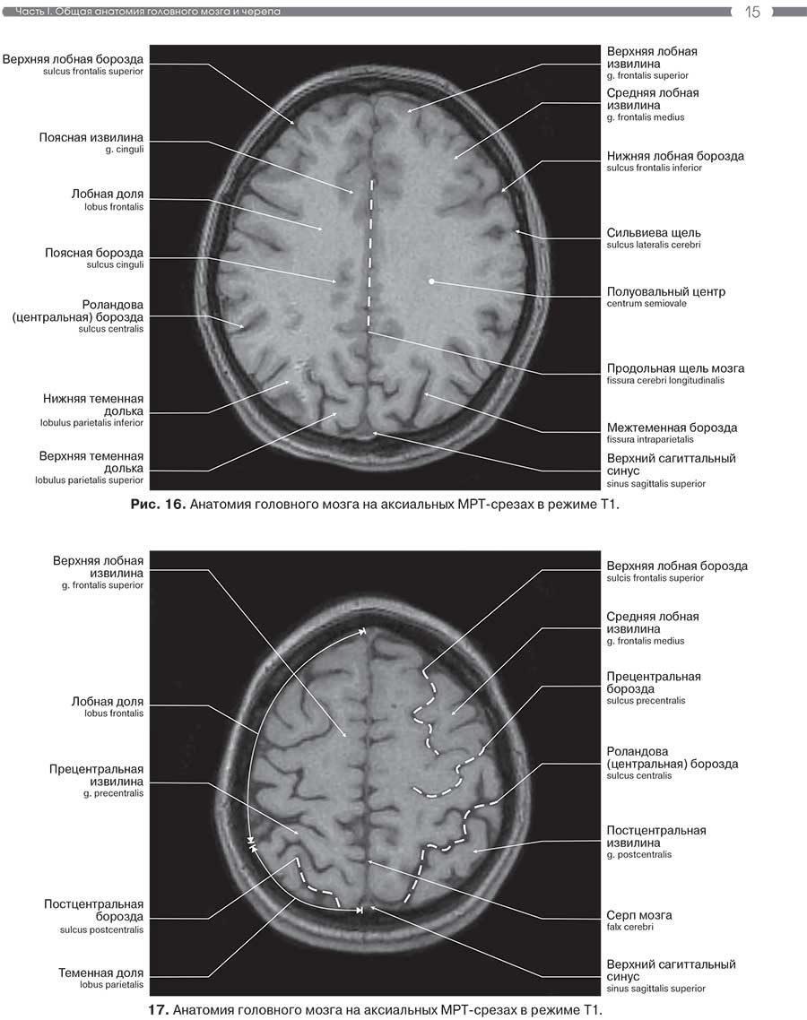 17. Анатомия головного мозга на аксиальных MPT-срезах в режиме Т1.