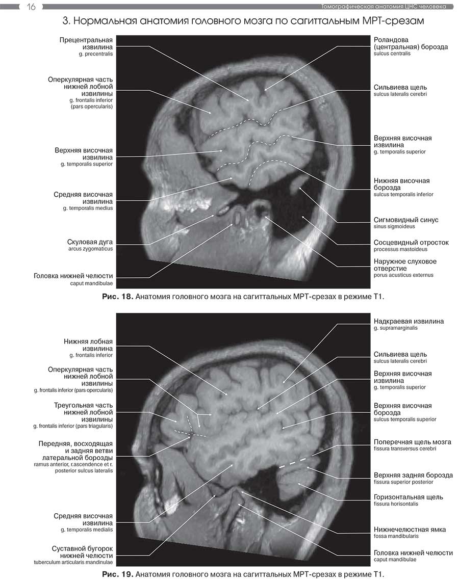 Рис. 19. Анатомия головного мозга на сагиттальных MPT-срезах в режиме Т1.
