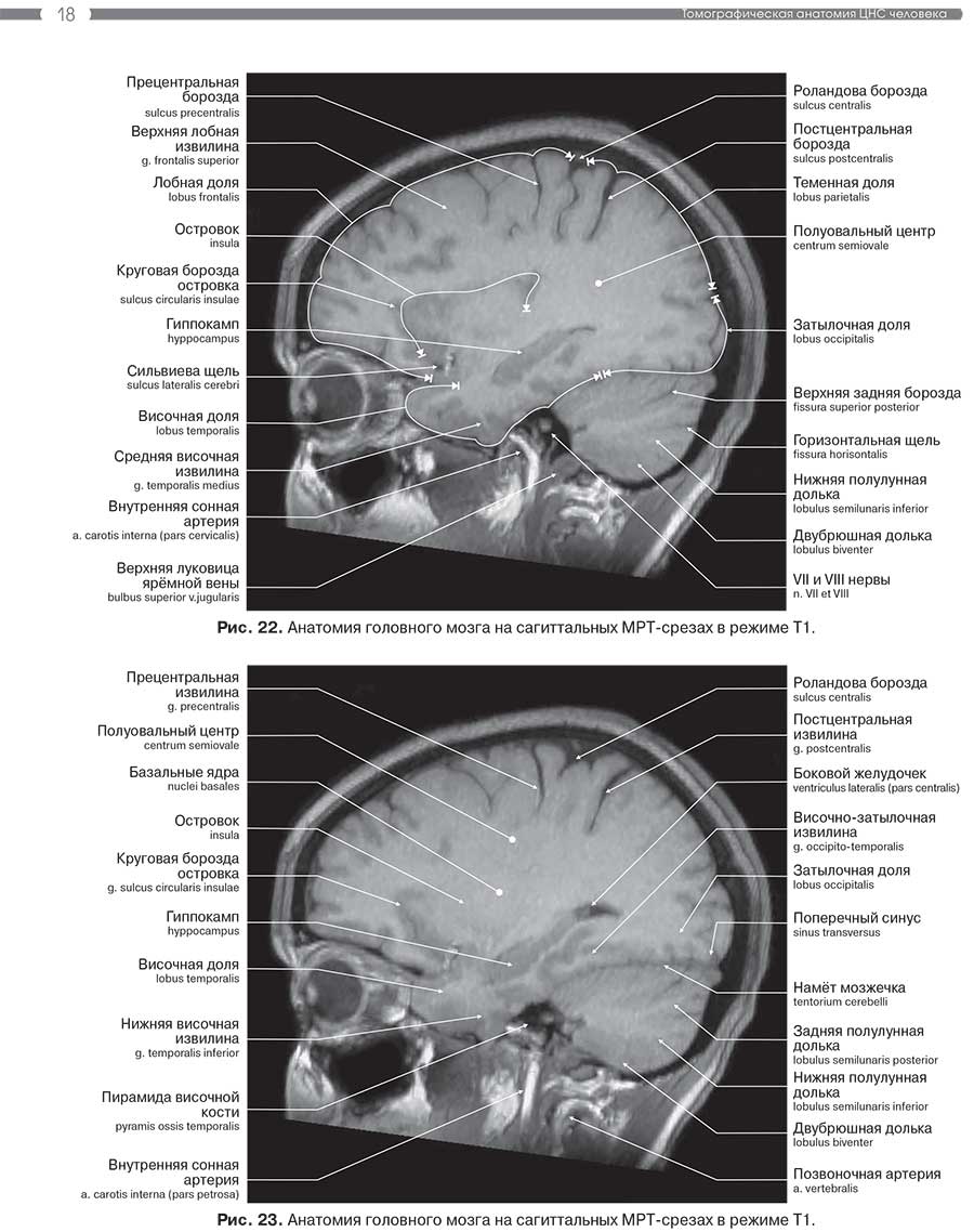 Рис. 23. Анатомия головного мозга на сагиттальных MPT-срезах в режиме Т1.