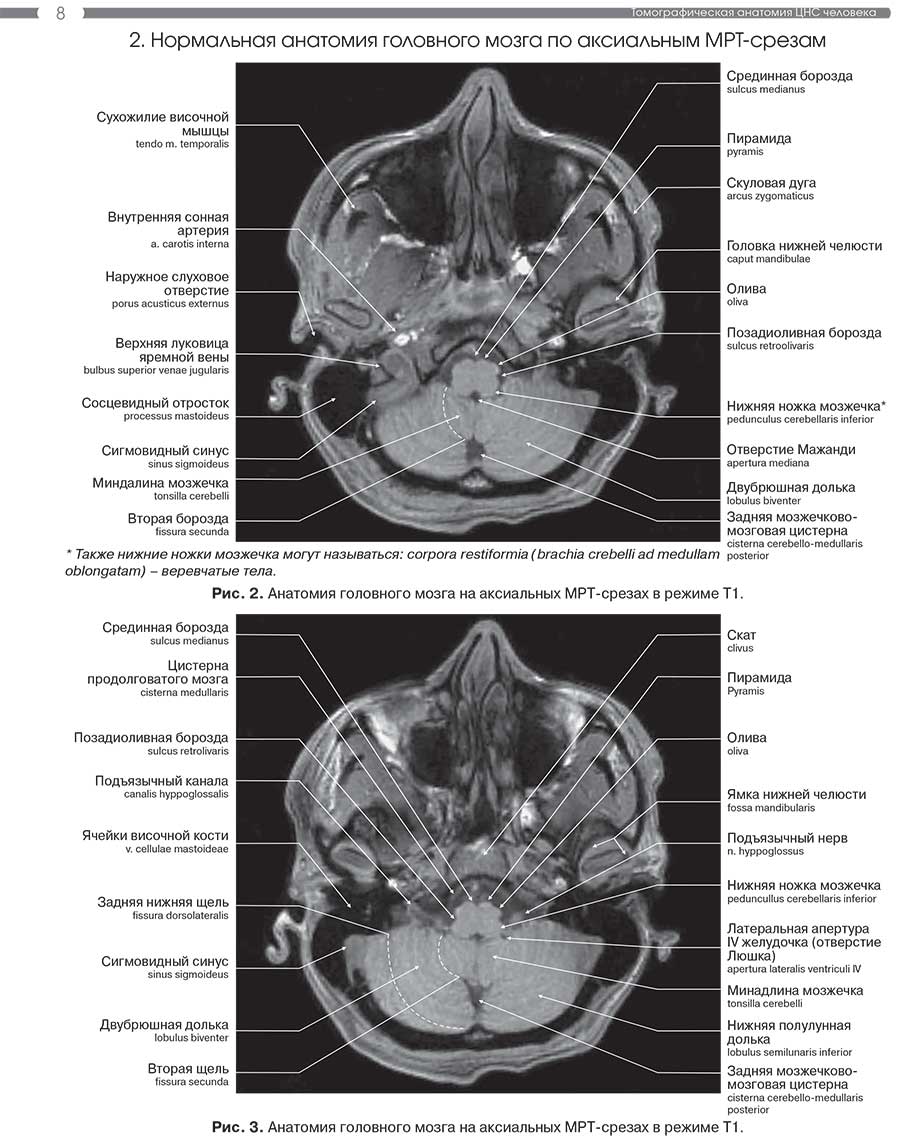 Рис. 3. Анатомия головного мозга на аксиальных MPT-срезах в режиме Т1.