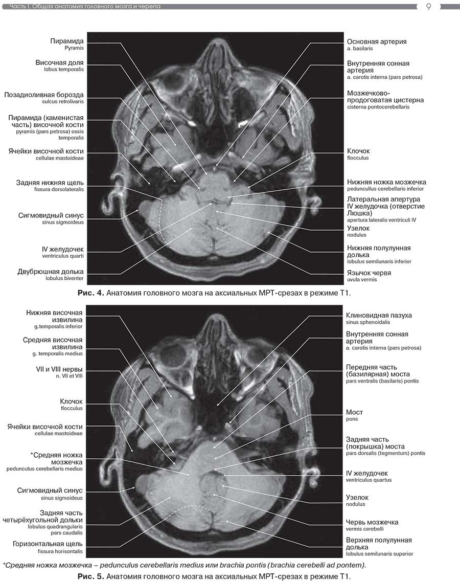 Рис. 5. Анатомия головного мозга на аксиальных MPT-срезах в режиме Т1.