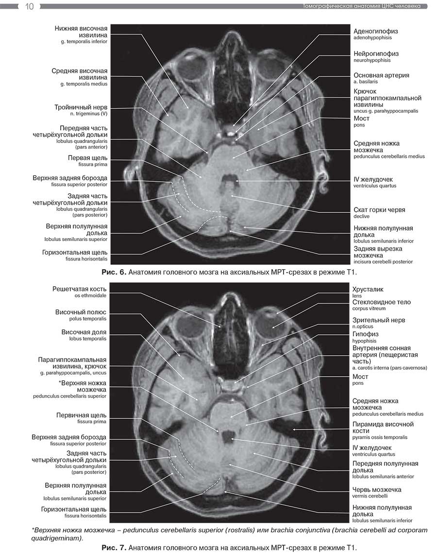 Рис. 7. Анатомия головного мозга на аксиальных MPT-срезах в режиме Т1.