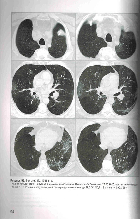 Вирусная пневмония неуточненная