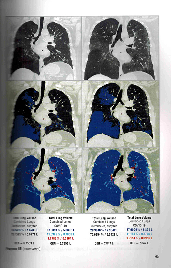 Пример страницы из книги "Заключения в торакальной компьютерной томографии. Симптом, синдром, диагноз" - А. А. Сперанская 