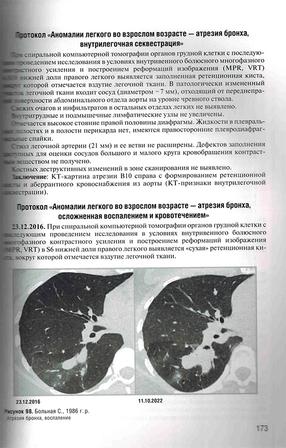 Атрезия бронха, воспаление