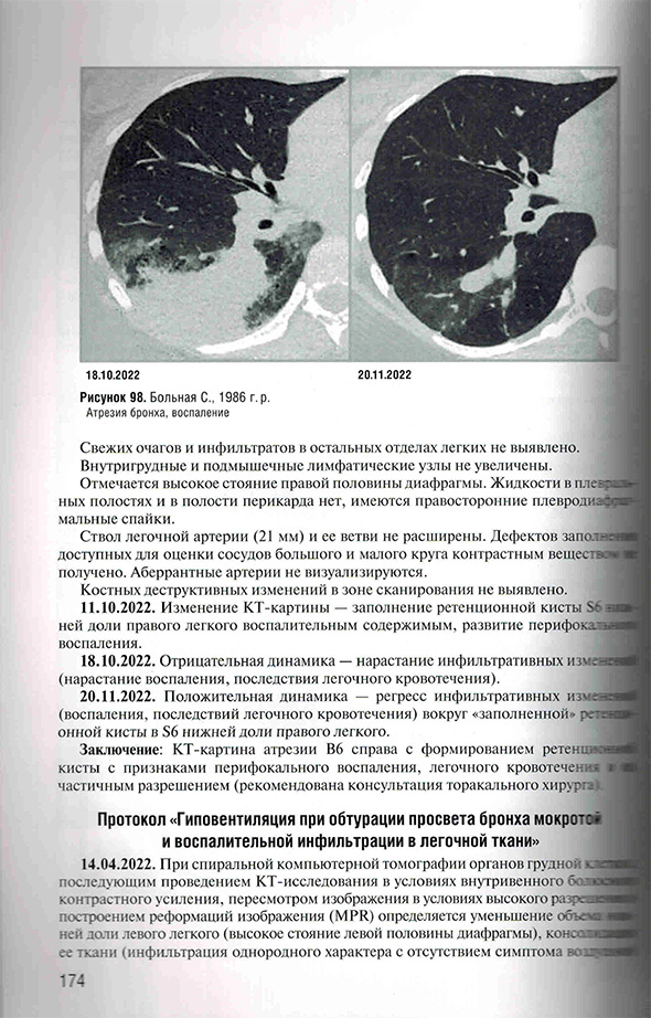 Атрезия бронха, воспаление