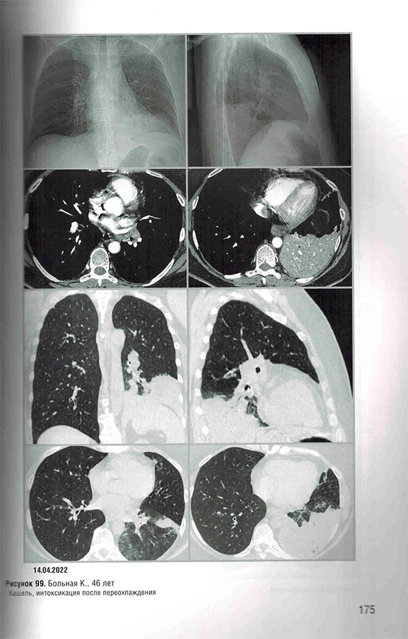 Пример страницы из книги "Заключения в торакальной компьютерной томографии. Симптом, синдром, диагноз" - А. А. Сперанская 