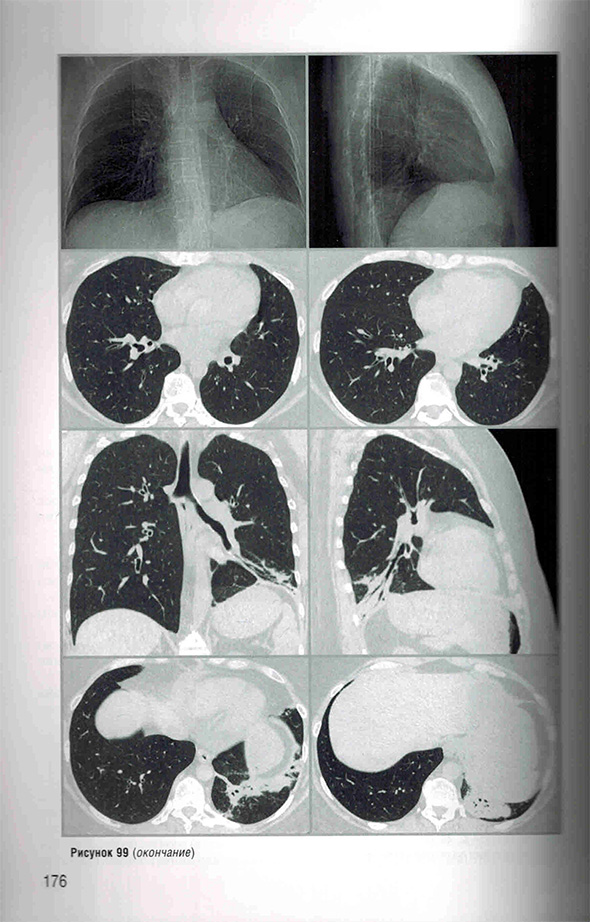 Пример страницы из книги "Заключения в торакальной компьютерной томографии. Симптом, синдром, диагноз" - А. А. Сперанская 