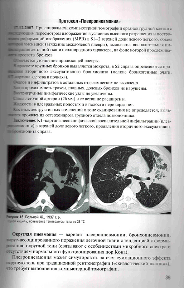 Пример страницы из книги "Заключения в торакальной компьютерной томографии. Симптом, синдром, диагноз" - А. А. Сперанская 