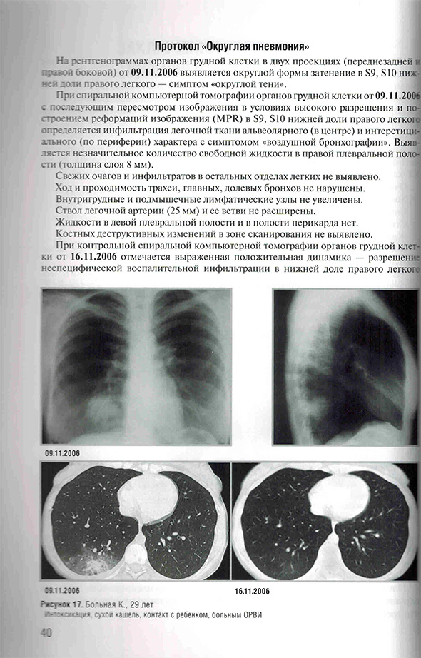 Пример страницы из книги "Заключения в торакальной компьютерной томографии. Симптом, синдром, диагноз" - А. А. Сперанская 