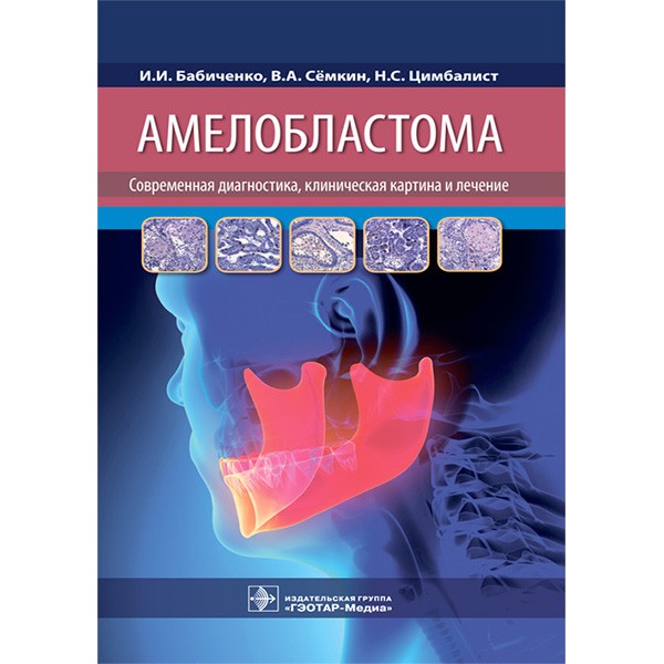 Амелобластома: современная диагностика, клиническая картина и лечение - Бабиченко И. И.