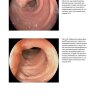 Пример страницы из книги "Атлас по эндоскопической диагностике колоректального эндометриоза" - Матроницкий Р. Б.