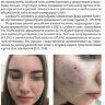 Пример страниц из книги "Акне и постакне. Руководство для врачей" — Бычкова Н. Ю., Максимова А. С., Загртдинова Р. М.