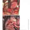 ​Пример страницы из книги "Атлас операций при злокачественных опухолях легкого, трахеи и средостения" - Чиссов В. И., Трахтенберг А. Х., Каприн А. Д.​