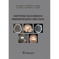 Хирургия массивного ишемического инсульта - Крылов В. В.