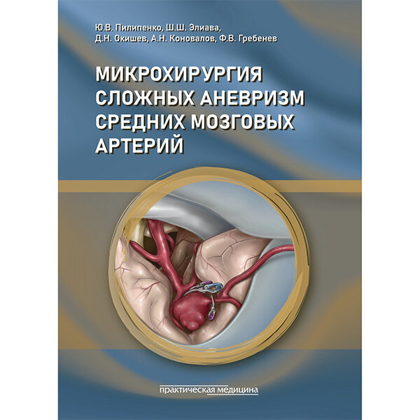 Микрохирургия сложных аневризм средних мозговых артерий - Пилипенко Ю. В., Элиава Ш. Ш., Окишев Д. Н., Коновалов А. Н., Гребенев Ф. В.