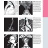 Пример страницы из книги "Лучевая диагностика. Опухоли органов грудной клетки" - Розадо-де-Кристенсон М. Л., Картер Б. В.
