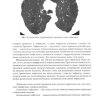 Пример страницы из книги "Тяжелая эмфизема легких" - Акопов А. Л.