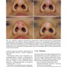 Пример страницы из книги "Осложнения после введения филлеров. Реакции гиперчувствительности, гранулема, некроз и слепота"