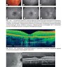 Пример страницы  "Оптическая когерентная томография сетчатки" - Дакер Дж. С.